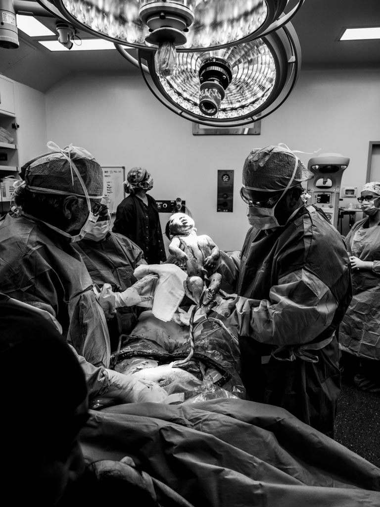 c-section-baby-delivery